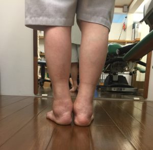 踵の痛みと歩行障害