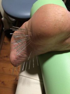 足底腱膜炎と鍼灸治療
